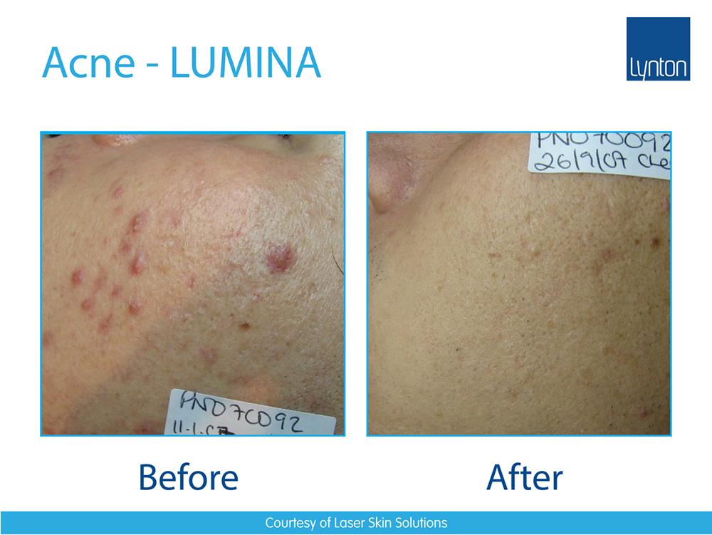 Acne Removal Laserclear Leeds Laser Hair Removal and Skin Clinic in