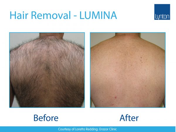 hair-removal-laserclear-leeds-laser-hair-removal-and-skin-clinic-in