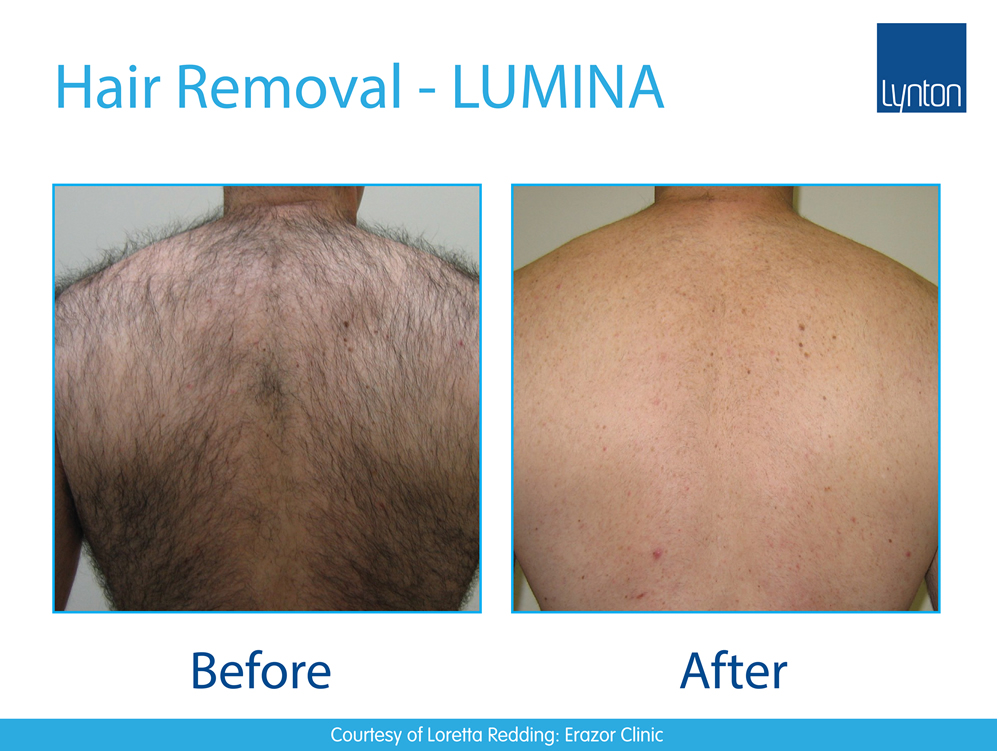 Hair Removal Laserclear Leeds Laser Hair Removal and Skin Clinic in