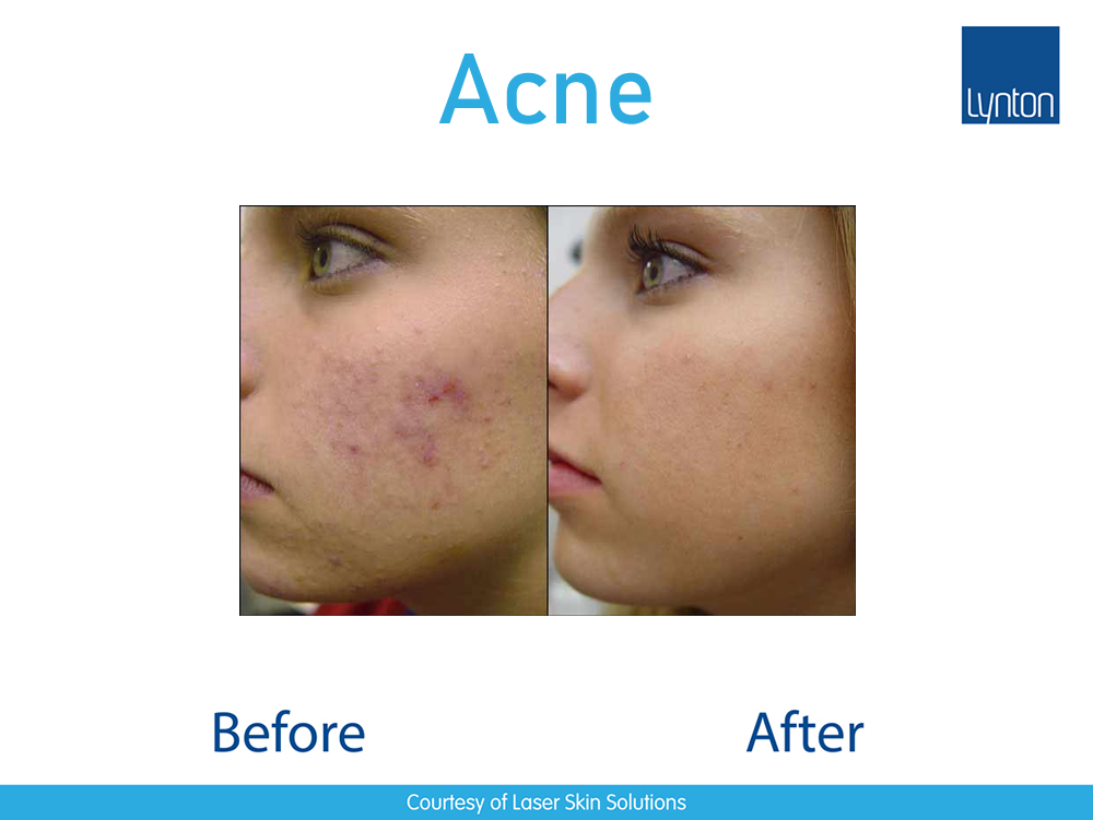 Acne Removal Laserclear Leeds Laser Hair Removal and Skin Clinic in