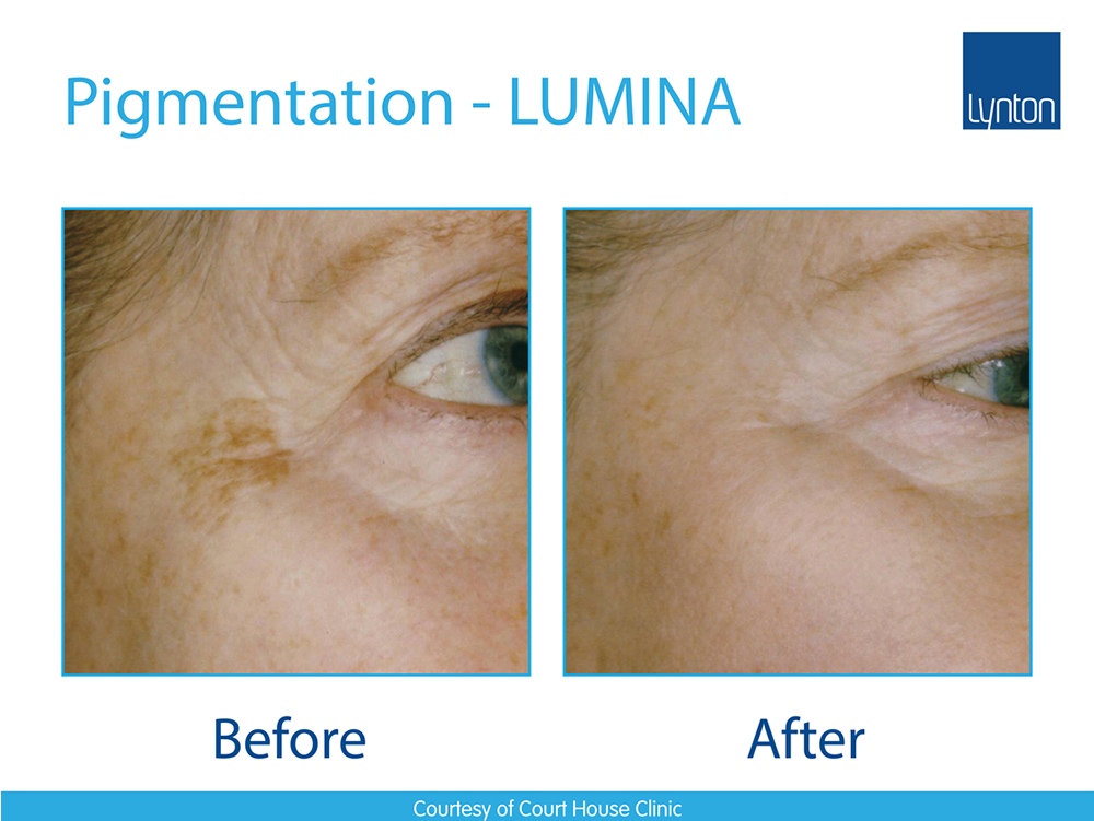 Pigment Removal Laserclear Leeds Laser Hair Removal and Skin Clinic